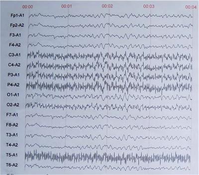 Delayed lethal central nervous system toxicity induced by a low-dose intrathecal administration of bupivacaine: case report